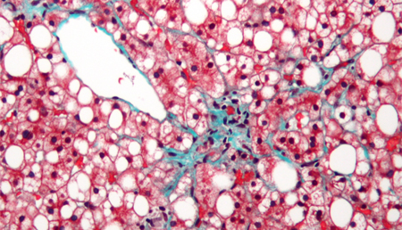 Descubren nuevos determinantes implicados en el desarrollo de hígado graso no alcohólico