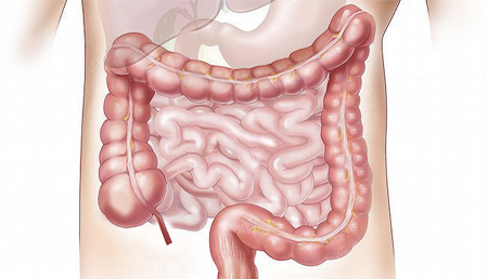 Memoria bacteriana de la inflamación intestinal