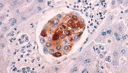 Científicos diseñan una técnica para detener la migración de las células cancerosas