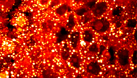 Un nuevo biomarcador de fracaso terapéutico y muerte precoz en cáncer de próstata