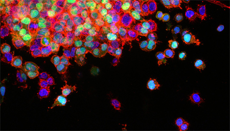 Un biomarcador podría detectar el cáncer de pulmón en las vías nasales