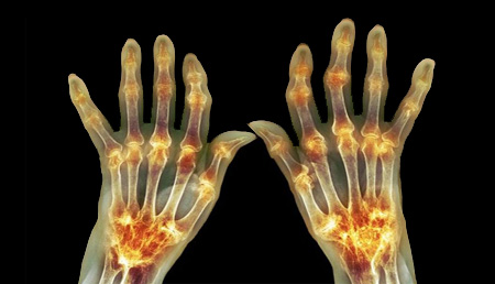 Efecto beneficioso de la interrupción de metotrexato en pacientes con artritis tras vacunación por SARS-CoV-2