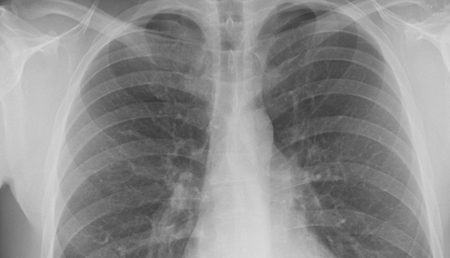 La población española con hipertensión pulmonar muestra un sustrato genético diferente