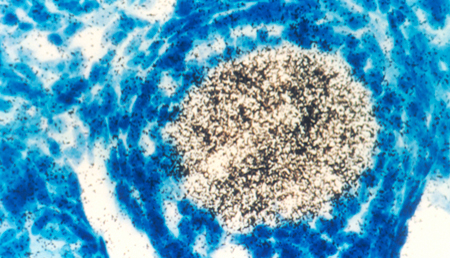 Variantes genéticas elevan la susceptibilidad al cáncer de boca y garganta