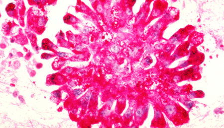 Marcadores epigenéticos para estudiar la progresión en el sarcoma de Ewing