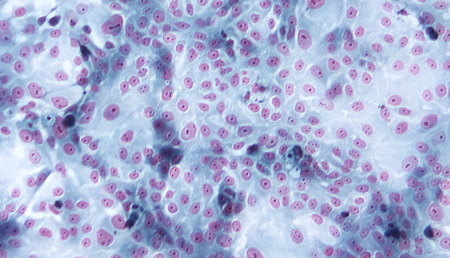 Una variante genética podría acelerar el envejecimiento normal del cerebro.
