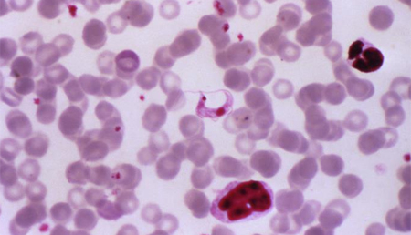 Posibles biomarcadores de pronóstico para la enfermedad de Chagas