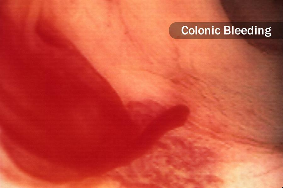 هل المنظار خطر؟