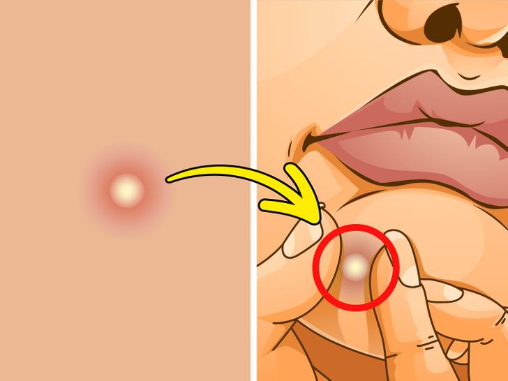 يجب ألا تفقع بثرة أبدًا يجب ألا تفقع بثرة أبدًا