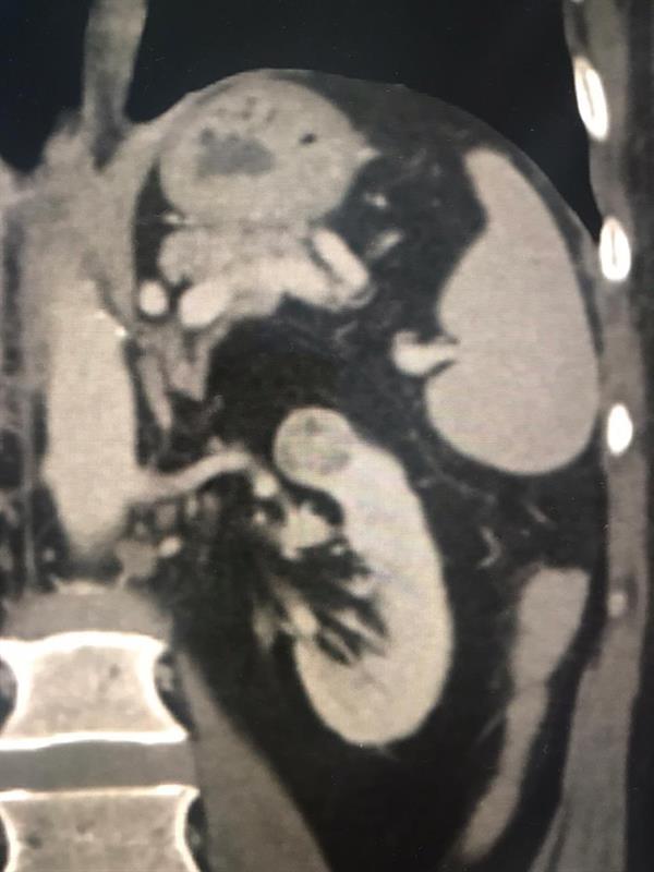 نجح فريق طبي بمدينة الملك عبدالله الطبية، من استئصال ورم سرطاني من الكلية اليسرى لمريض بالعقد السادس من العمر مع الحفاظ عليها وعلى وظيفتها بتقنية التبريد.  وأبانت مدينة الملك عبدالله الطبية، أن العملية تعد الأولى من نوعها على مستوى المنطقة الغربية، كما جرى تطبيق كافة الإجراءات الاحترازية الوقائية.
