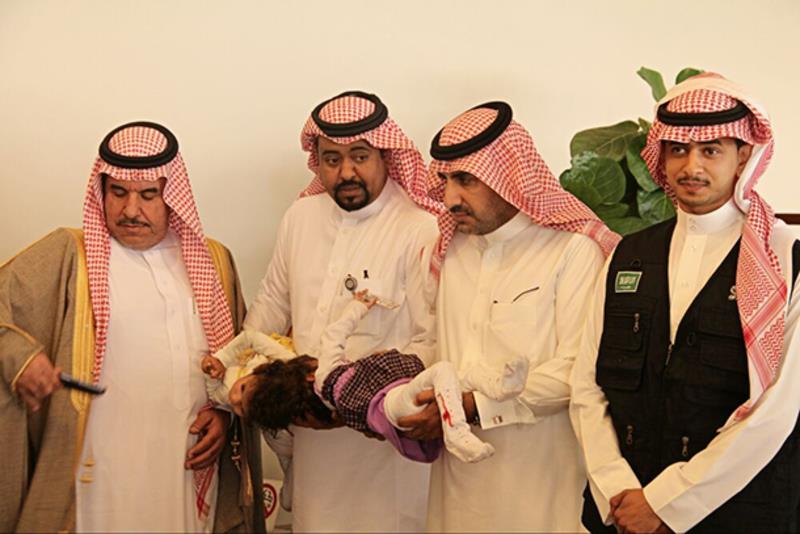 إجراء إحدى أصعب العمليات السيامية بفصل التوأم 