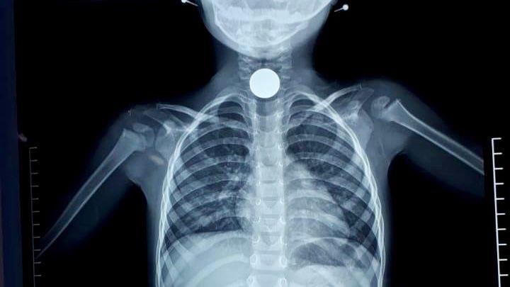 الجوف: إنقاذ طفلة عقب انسداد مجرى الهواء بقطعة معدنية