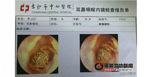 صورة العنكبوت داخل اذن الصينية