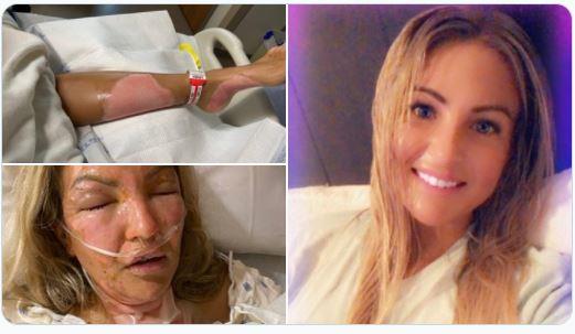 شمعة ومعقم يدين يحولان حسناء لامرأة مشوهة .. وهذه قصتها