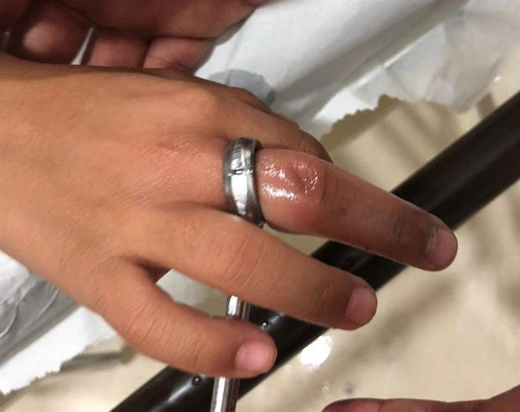 شاهد.. أصبع طفل تعلق داخل حلقة مفتاح والدفاع المدني يتدخل ‏