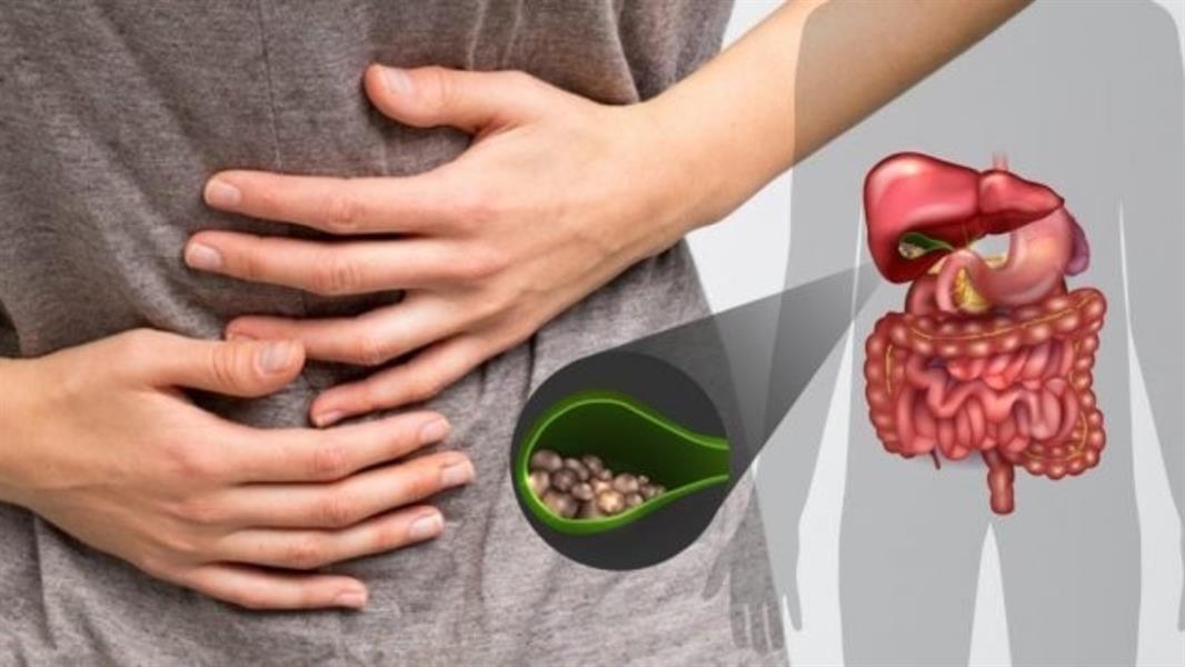 حصى المرارة.. مكوناتها وأعراضها وطرق العلاج 