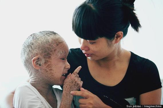 مرض جلدي نادر