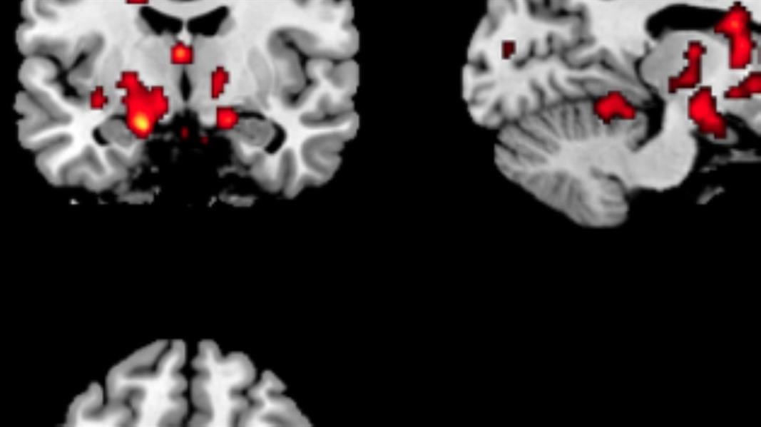 هل تتذكر أدق تفاصيل حياتك؟.. قد تكون مصـابًا بهذا المرض هل تتذكر أدق تفاصيل حياتك؟.. قد تكون مصـابًا بهذا المرض