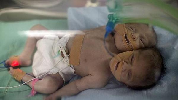 بالصور.. ولادة توأم سيامي 