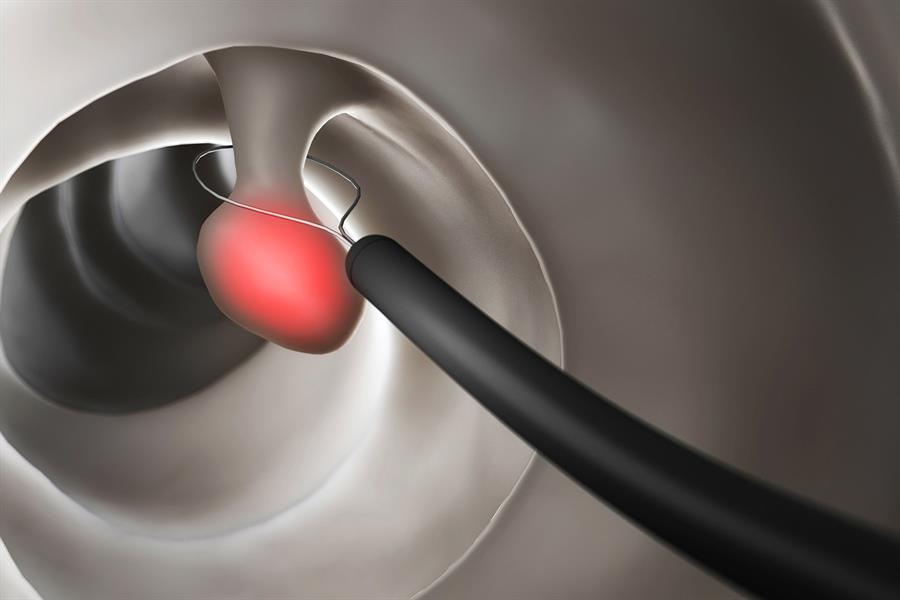 إزالة الأورام الحميدة