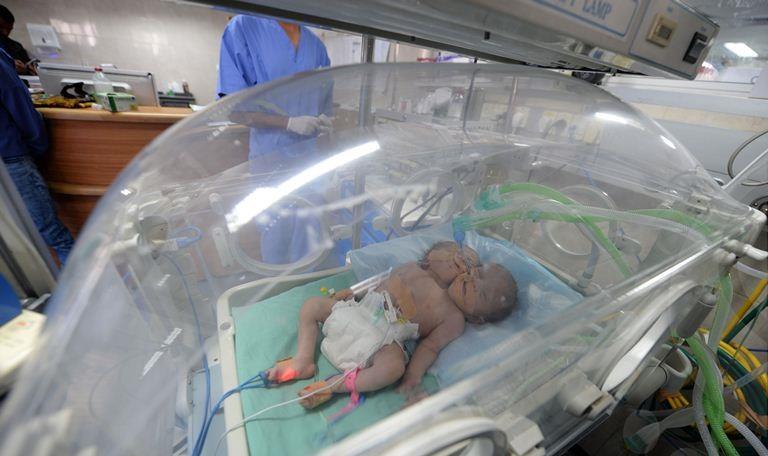 بالصور.. ولادة توأم سيامي 