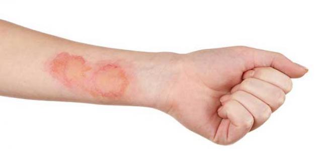 الامراض الجلدية الامراض الجلدية