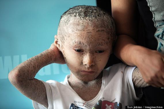 مرض جلدي نادر