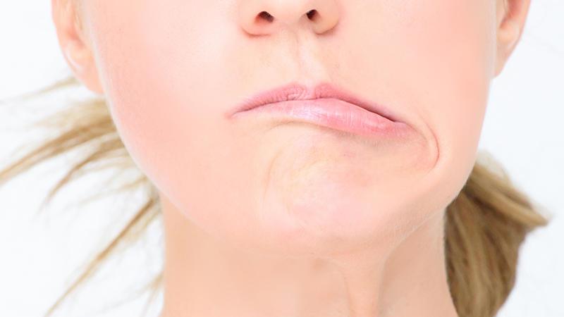 علامات تدل على الإصابة بشلل الوجه النصفي .. تعرف عليها