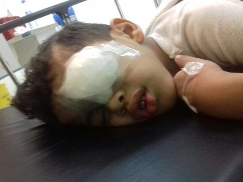 الطائف: انفجار لعبة نارية في عين الطفل تتسبب في تضرر الشبكية والقرنية