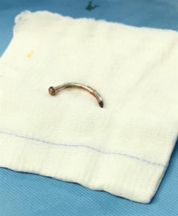 استخراج أجسام معدنية من فك مصاب بـ