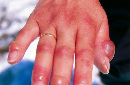 تعرّف على أعراض مرض 