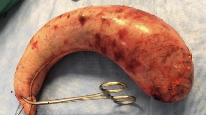 فنانة كويتية تنشر صورة معدتها بعد استئصال جزء منها فنانة كويتية تنشر صورة معدتها بعد استئصال جزء منها