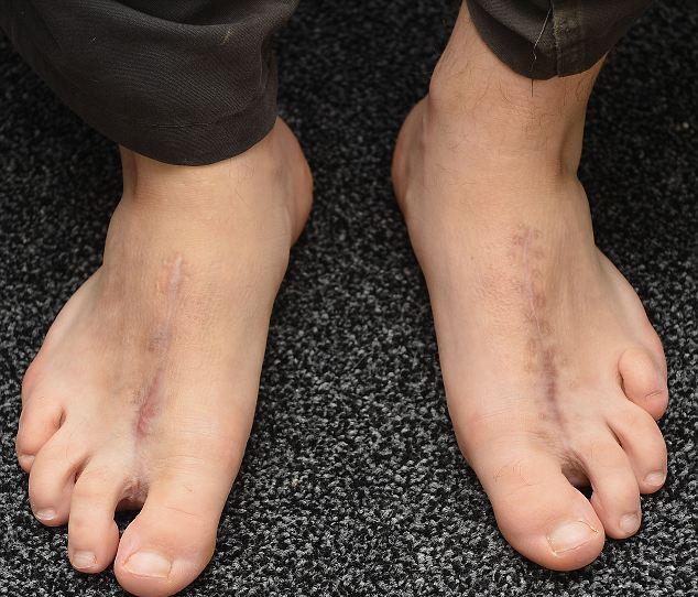 بريطاني يستبدل أصابع يديه بأصابع قدميه