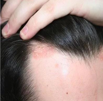 التهاب الجلد