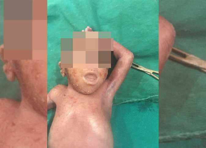 ولادة طفل بعين واحدة في مصر 