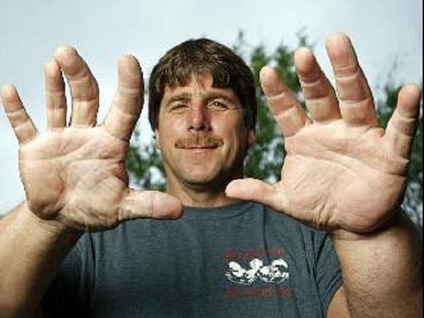 أمريكي يمتلك يدًا ضخمة تشبه يد شخصية باباي الكرتونية- صور