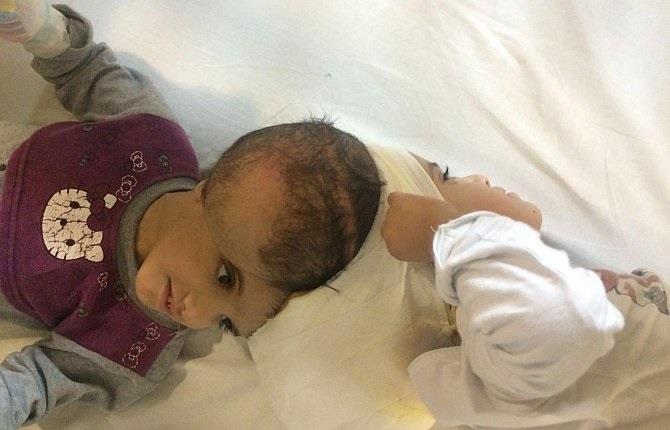 إجراء إحدى أصعب العمليات السيامية بفصل التوأم 