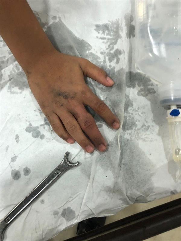 شاهد.. أصبع طفل تعلق داخل حلقة مفتاح والدفاع المدني يتدخل ‏