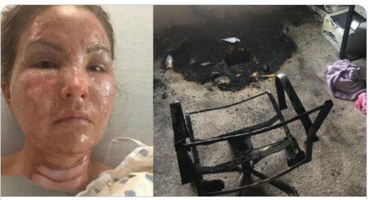 شمعة ومعقم يدين يحولان حسناء لامرأة مشوهة .. وهذه قصتها