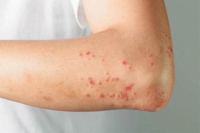 جدري الماء جدري الماء