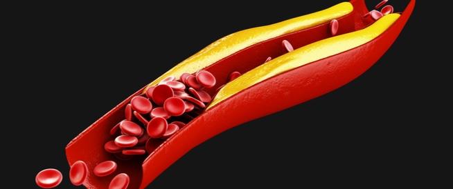 الكوليسترول