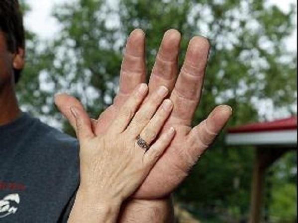 أمريكي يمتلك يدًا ضخمة تشبه يد شخصية باباي الكرتونية- صور