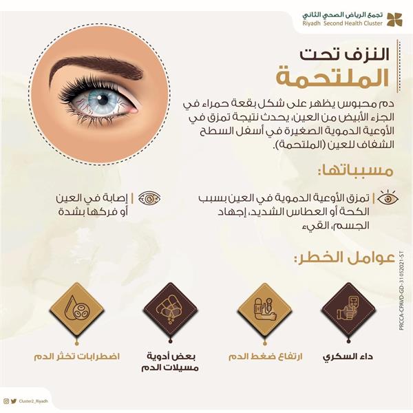 ما هو النزيف تحت الملتحمة وأسبابه؟.. 