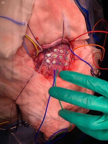 لتجنب تلف المراكز الحيوية.. إيقاظ طفل خلال عملية جراحية في الدماغ بالدمام 