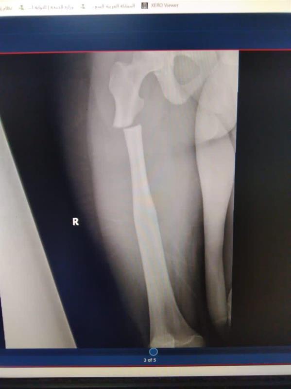 نجاح جراحة معقدة لحالتين تعانيان مرض نجاح جراحة معقدة لحالتين تعانيان مرض