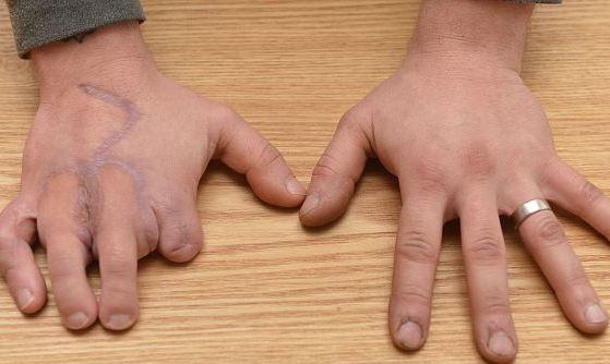 بريطاني يستبدل أصابع يديه بأصابع قدميه