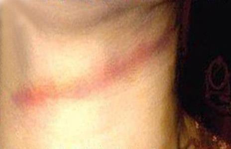 اثار الحبل على رقبة فاطمة عبد الرحيم