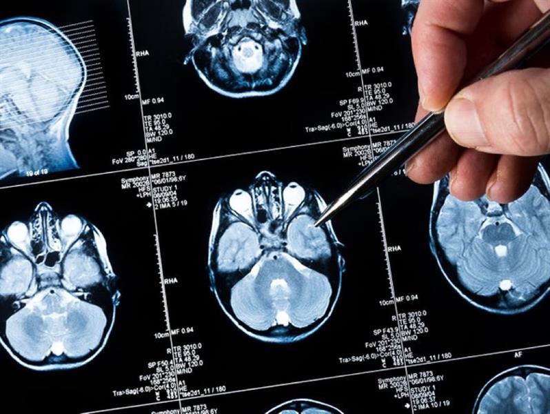 نتائج واعدة لاختبار أول لقاح مضاد لسرطان الدماغ