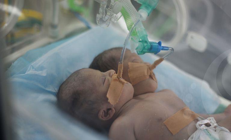 بالصور.. ولادة توأم سيامي 