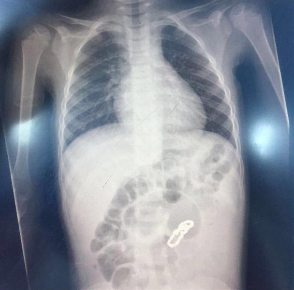 مستشفى أطفال بجدة يخرج قطعاً معدنية من بطن طفل مستشفى أطفال بجدة يخرج قطعاً معدنية من بطن طفل